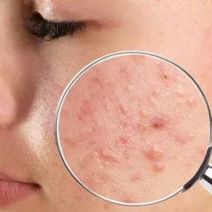 Acne Facial