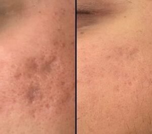 PRP Deep Scar