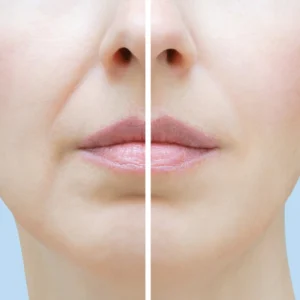 Nasolabial Fold Filler
