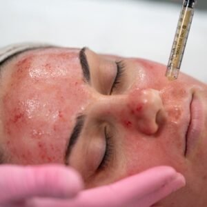 PRP Vampire Facial