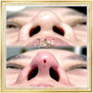 HIKO MAX (Nose Thread lift)