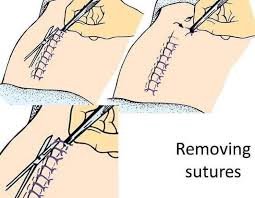 Suture Removal